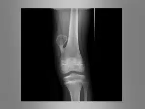 Osteochondroma